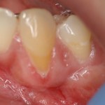 Picture of Gums before Gum Grafting Treatment