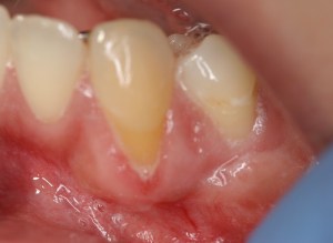 Picture of Gums before Gum Grafting Treatment