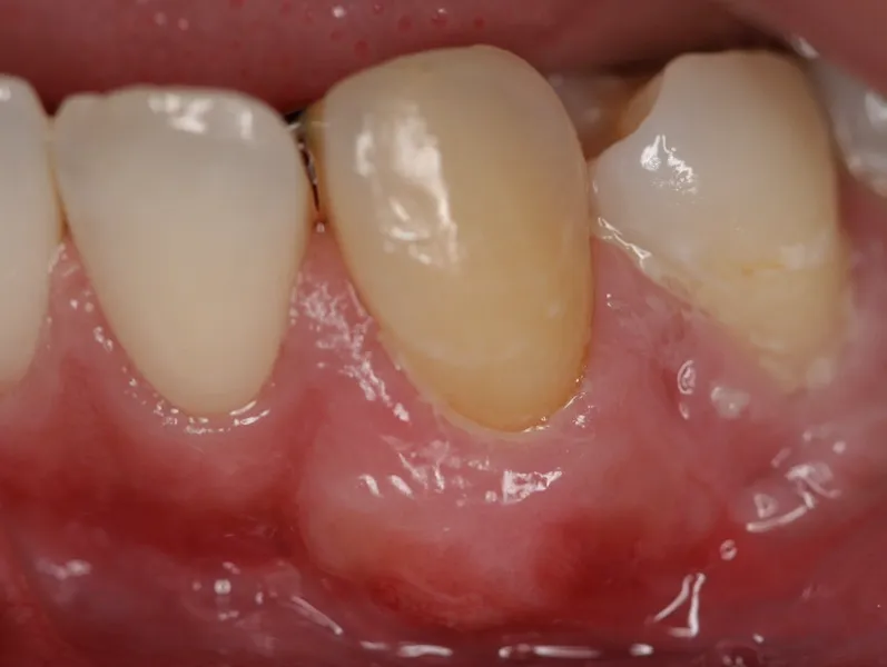 Photo After Receiving Gum Grafting Treatment