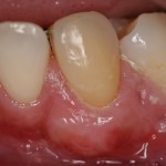 Photo After Receiving Gum Grafting Treatment