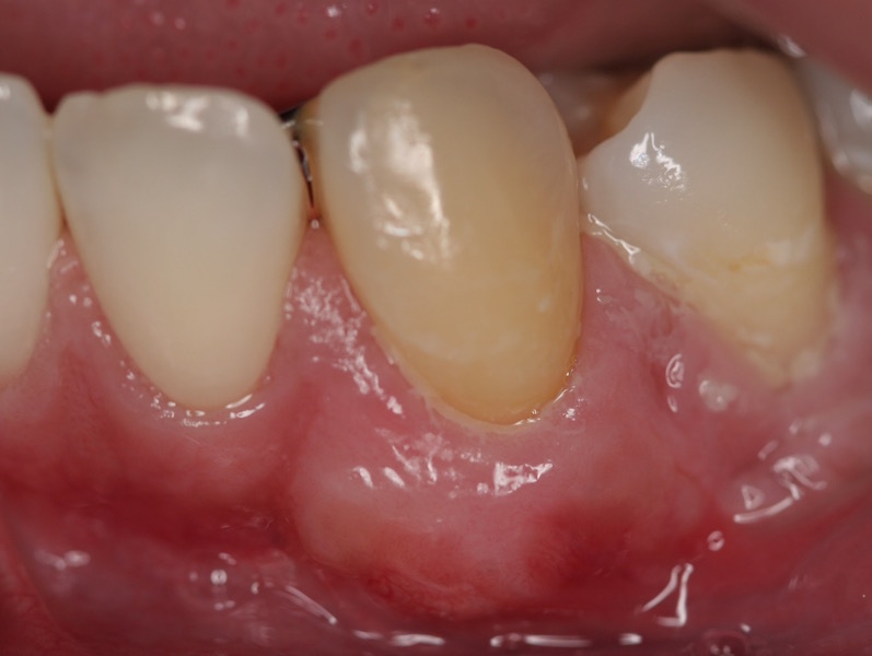 Photo After Receiving Gum Grafting Treatment