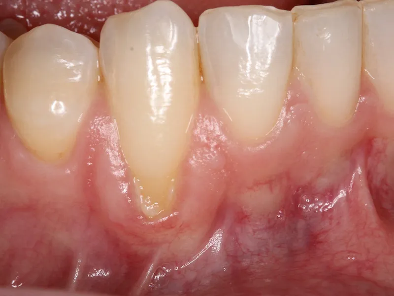 Picture of Receding Gum