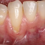 Picture of Receding Gum