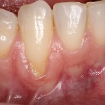 Picture of Receding Gum
