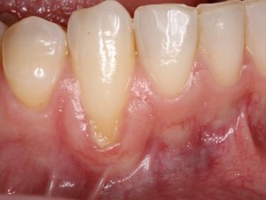 Picture of Receding Gum