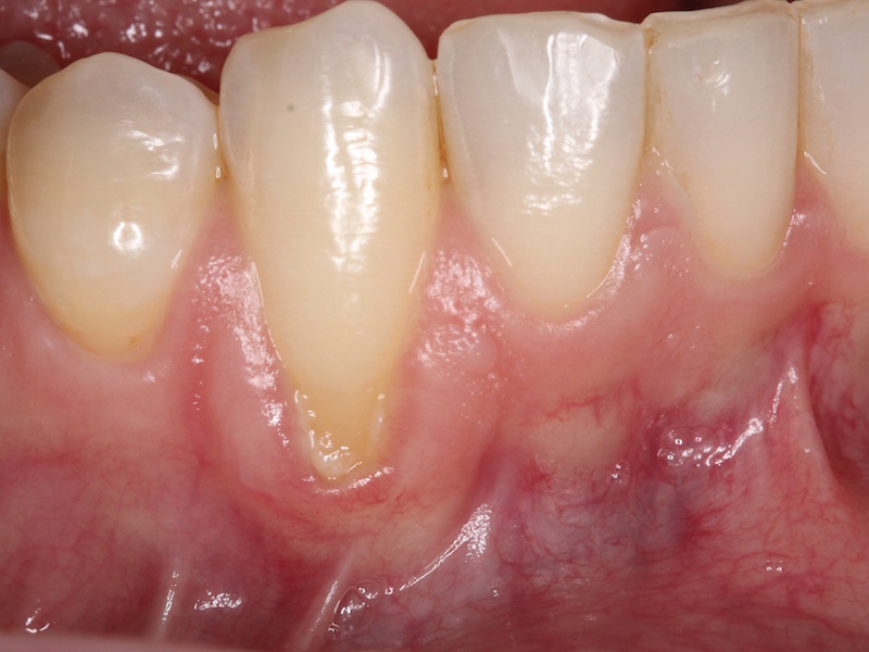Picture of Receding Gum