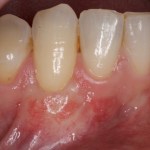 Picture of After Gum Grafting Treatment