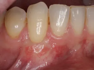 Picture of After Gum Grafting Treatment