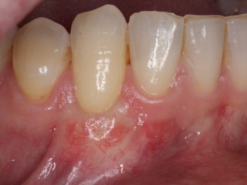 Picture of After Gum Grafting Treatment