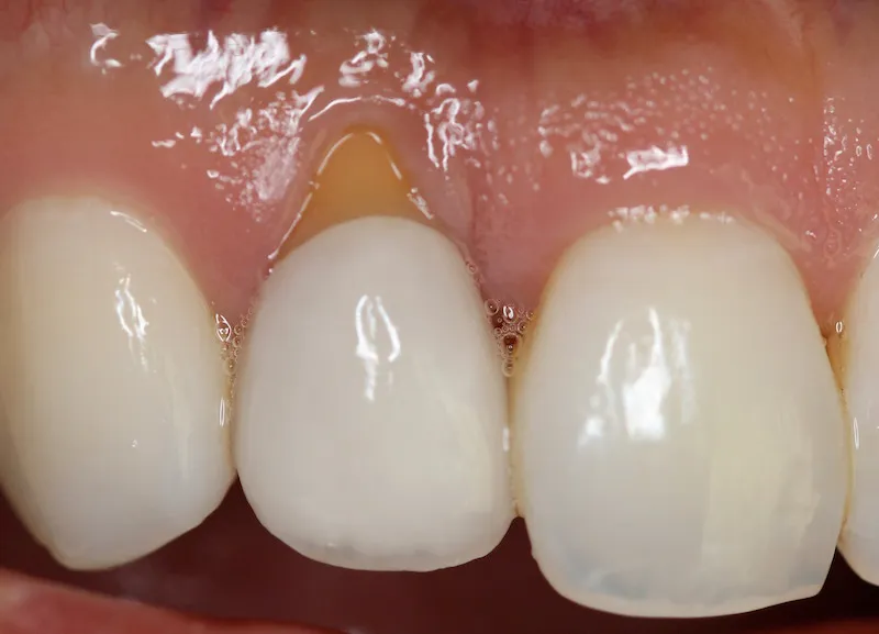 Photo of teeth after gum grafting treatment
