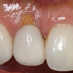 Photo of teeth after gum grafting treatment