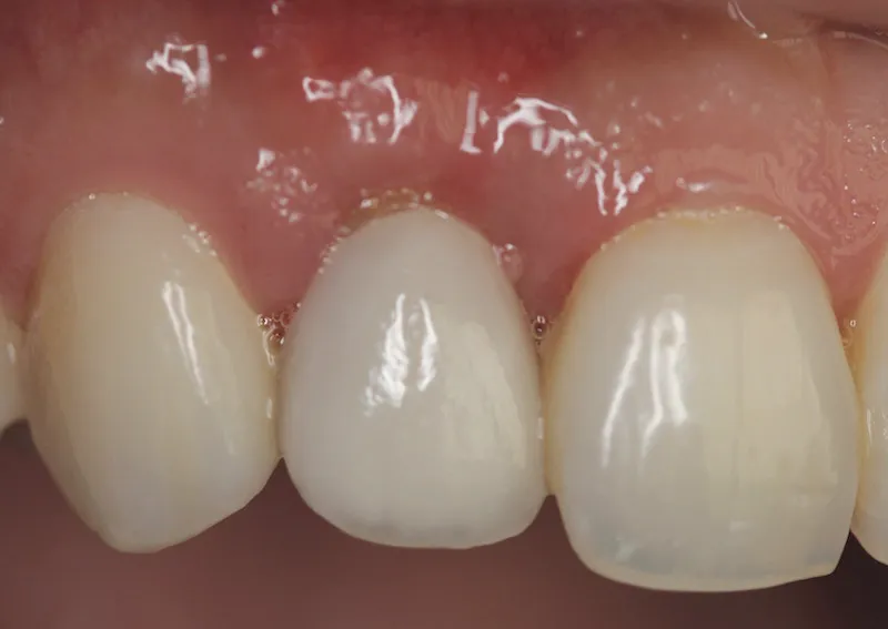 Photo of teeth after gum grafting treatment