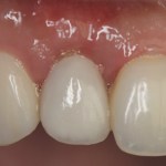 Photo of teeth after gum grafting treatment