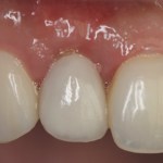 Photo of teeth after gum grafting treatment