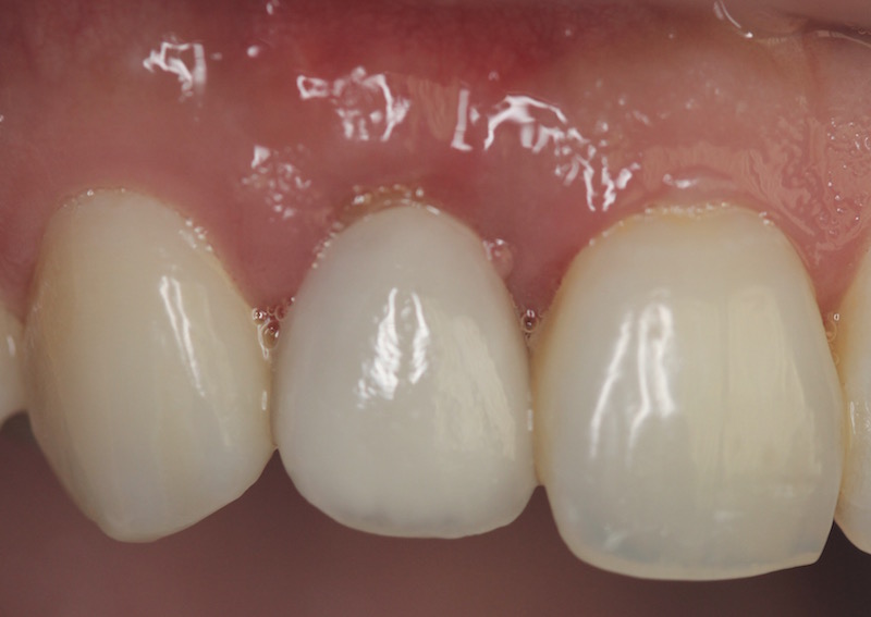 Photo of teeth after gum grafting treatment