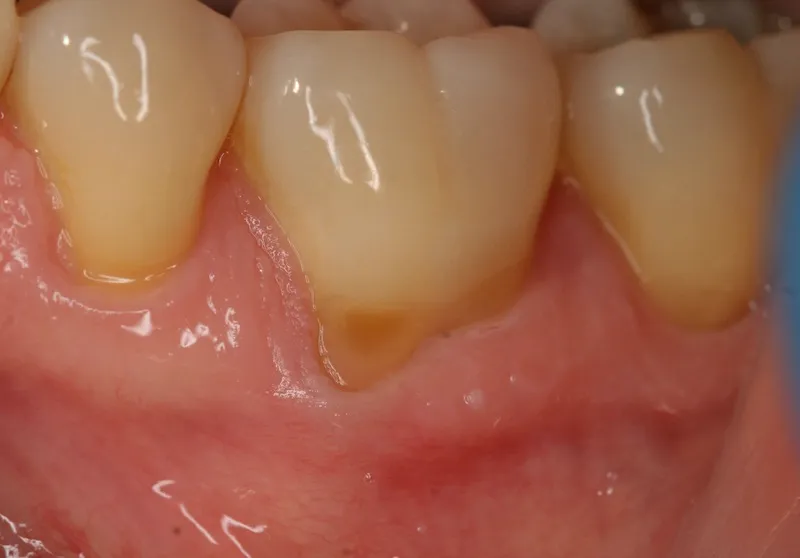 Photo of teeth before gum grafting treatment