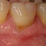 Photo of teeth before gum grafting treatment