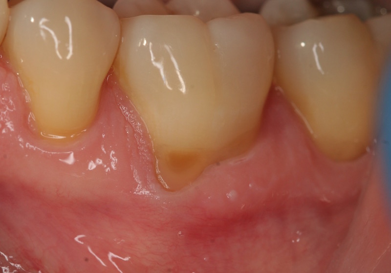 Photo of teeth before gum grafting treatment