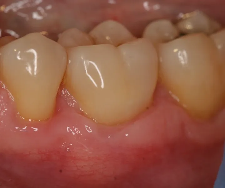 Photo of teeth before gum grafting treatment