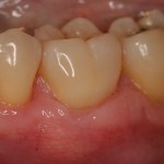Photo of teeth before gum grafting treatment
