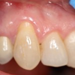 Picture of tooth before gum grafting treatment