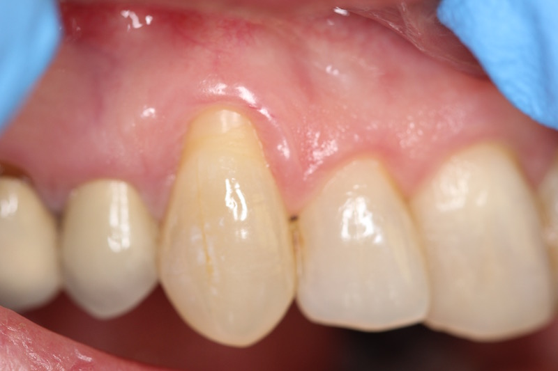 Picture of tooth before gum grafting treatment