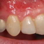 picture of tooth after gum grafting treatment