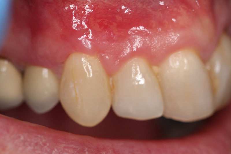 picture of tooth after gum grafting treatment