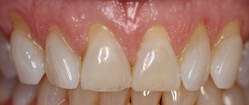 After photo of cosmetic periodontal treatment