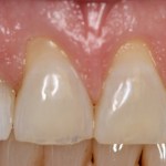 After photo of cosmetic periodontal treatment