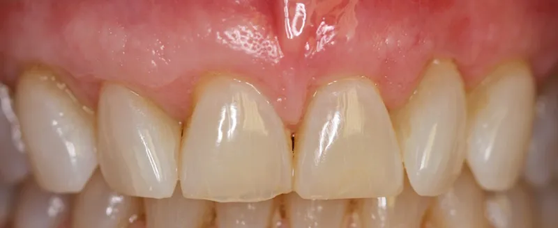 After photo of cosmetic periodontal treatment