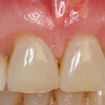 After photo of cosmetic periodontal treatment