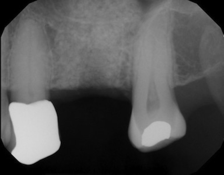 Sinus Augmentation