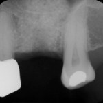 Sinus Augmentation	