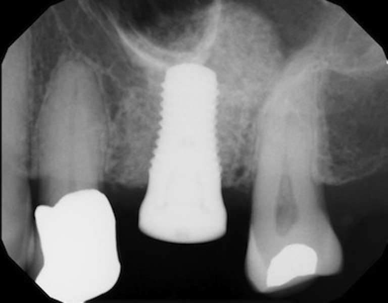 Sinus Augmentation
