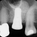 Sinus Augmentation	