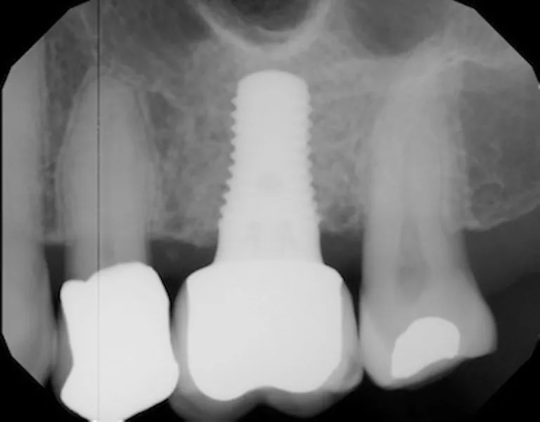Sinus Augmentation