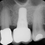 Sinus Augmentation	