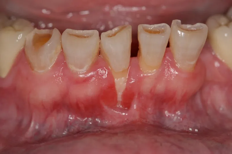 Crown Lengthening Before Picture
