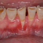 Crown Lengthening Before Picture