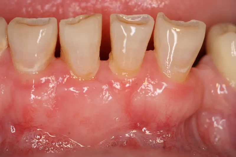 Crown Lengthening Before Picture