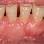 Crown Lengthening Before Picture