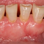 Crown Lengthening Before Picture