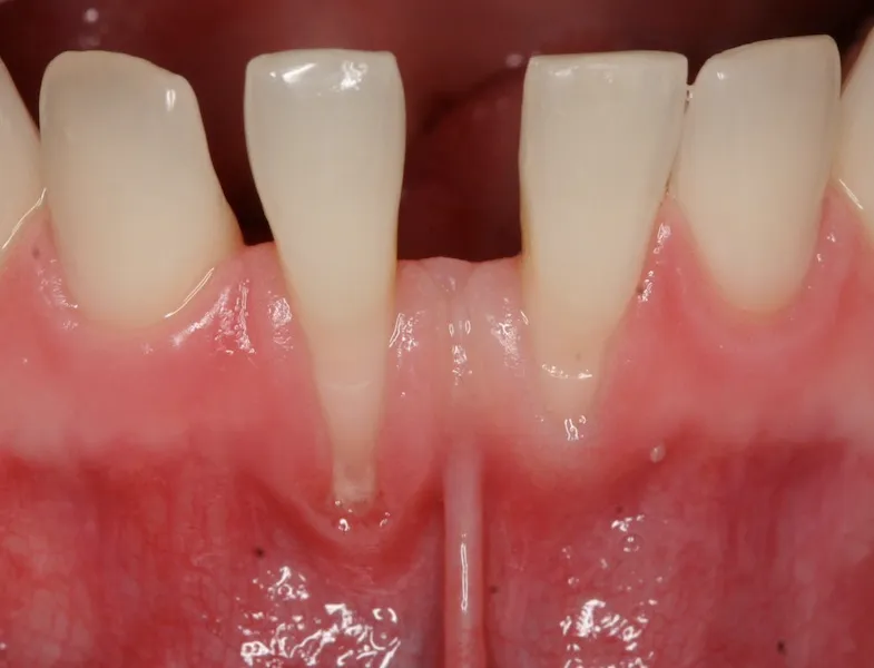 Picture of teeth before Crown Lengthening Treatment