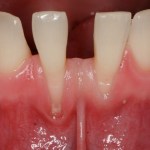 Picture of teeth before Crown Lengthening Treatment