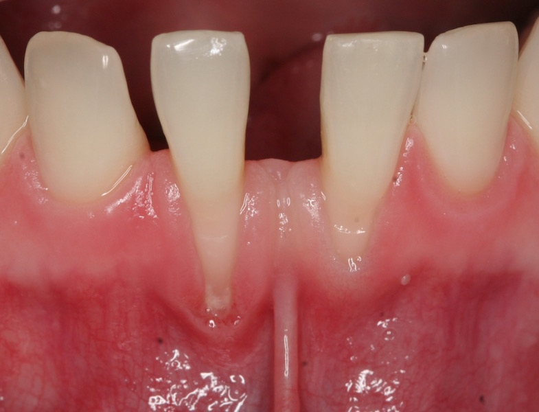 Picture of teeth before Crown Lengthening Treatment