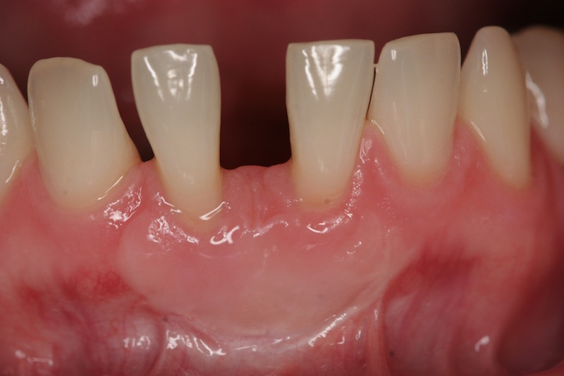 Picture of teeth before Crown Lengthening Treatment