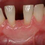 Picture of teeth before Crown Lengthening Treatment