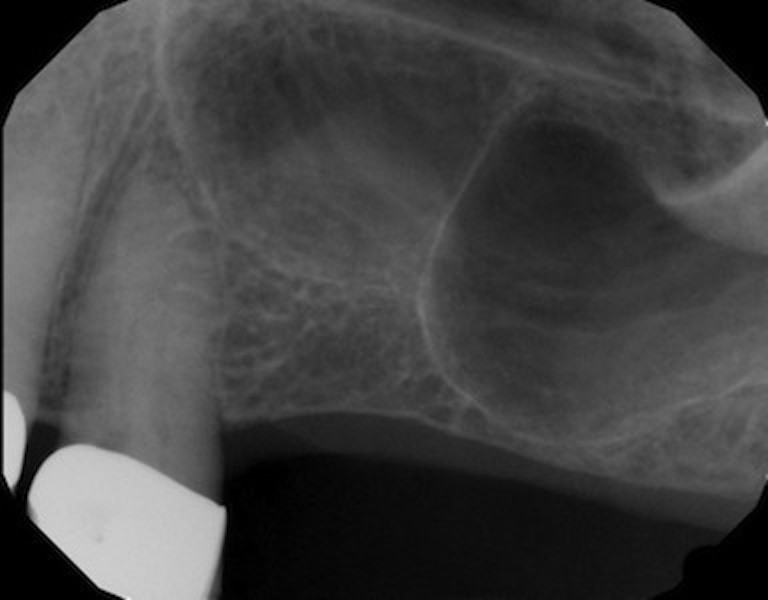 Sinus Augmentation