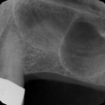 Sinus Augmentation	